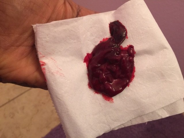 Heavy bleeding with Huge blood clots
