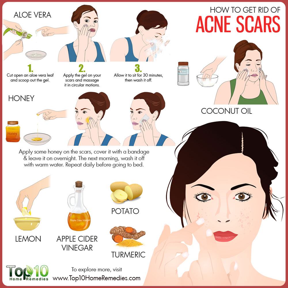 How to Get Rid of Acne Scars