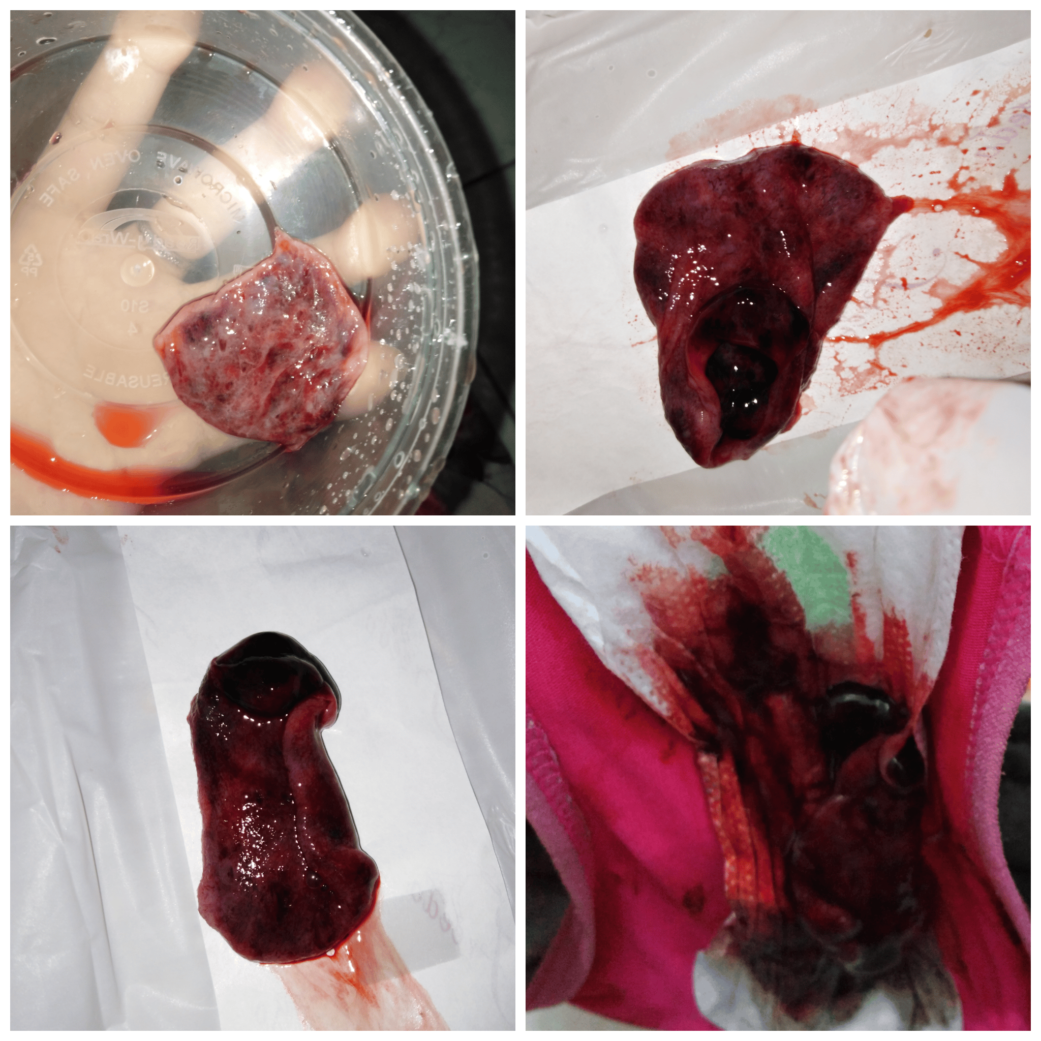 Implantation Bleeding Or Period : Implantation Bleeding