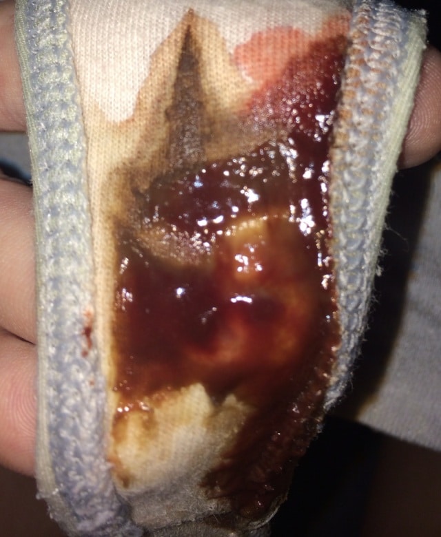 Is Implantation Bleeding Watery Brown