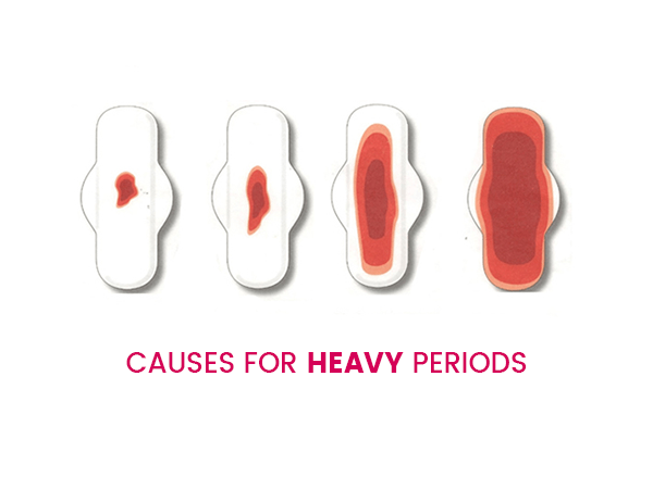 PCOS and heavy periods symptoms
