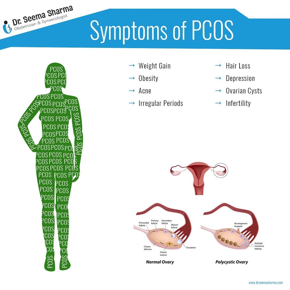 Pcos : PCOS :symptoms, advice and coping strategies, from women ...