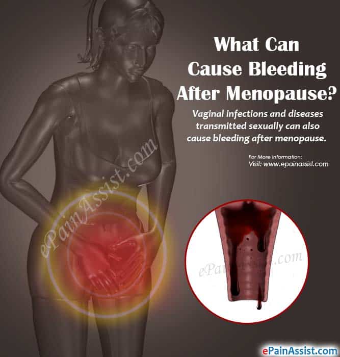 What Can Cause Bleeding after Menopause &  How is it Treated?