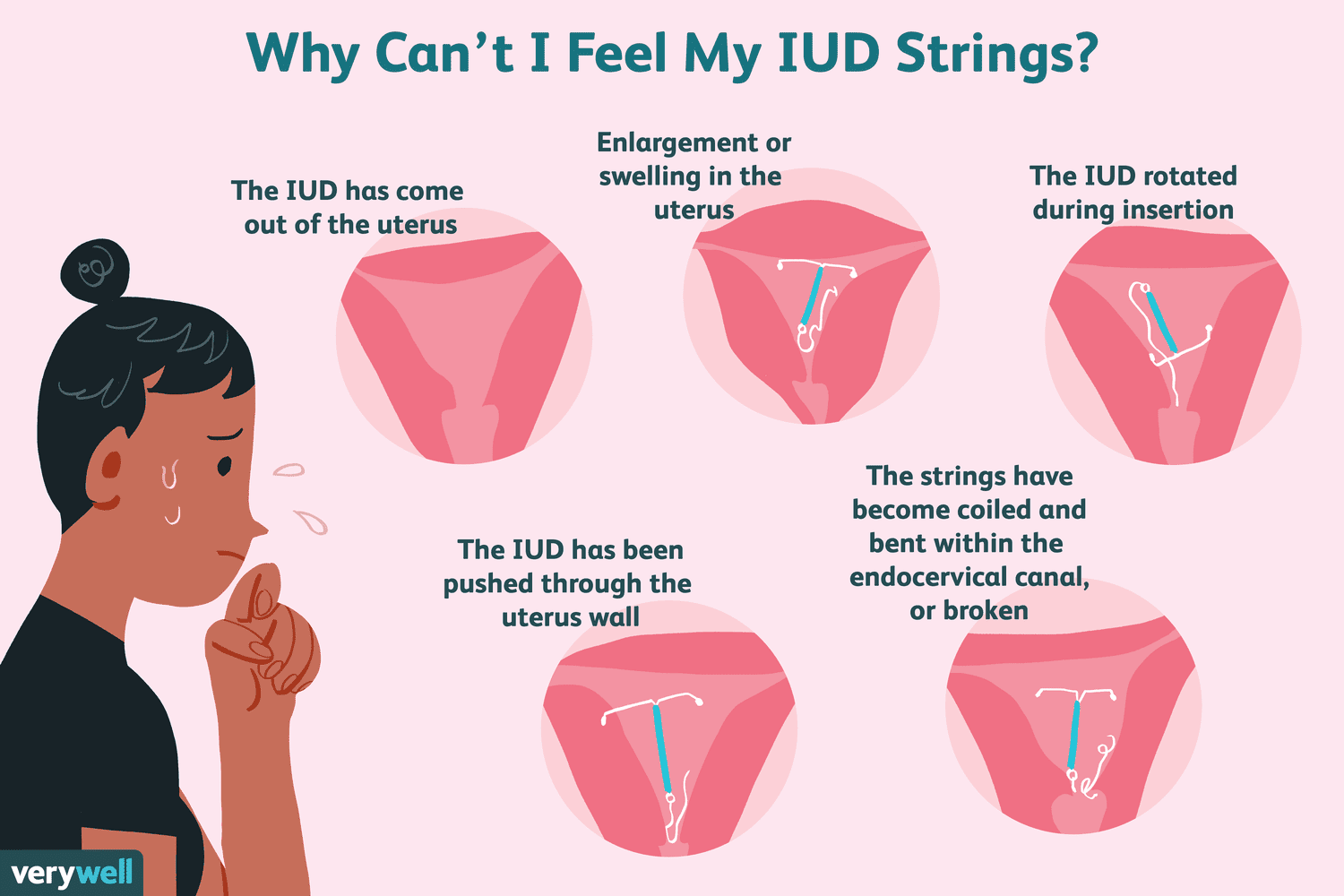 What to Do If Your IUD Strings Seem to Be Missing