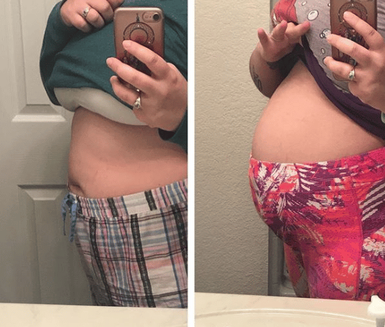 Women share photos of their bloated bellies to show painful reality of ...